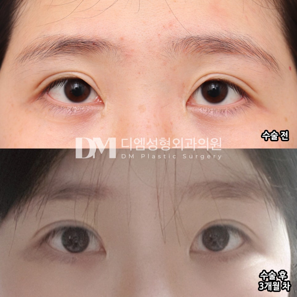 눈재수술 후기."고민이던 부분이 다 개선된 것 같아서 만족입니다!" 관련 이미지 2