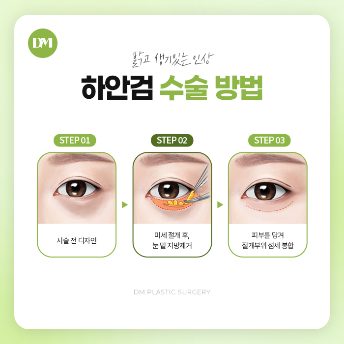 하안검, 밝고 젊어보이는 인상 만들기 관련 이미지 10