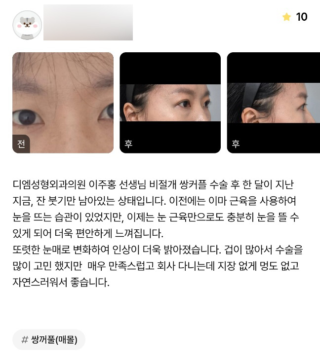 눈성형 후기."또렷한 눈매로 변화하여 인상이 더욱 밝아졌습니다" 관련 이미지 1