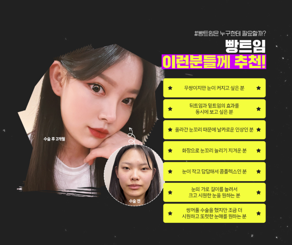 뒤밑트임, 흉터없이 순한 눈매로 관련 이미지 6