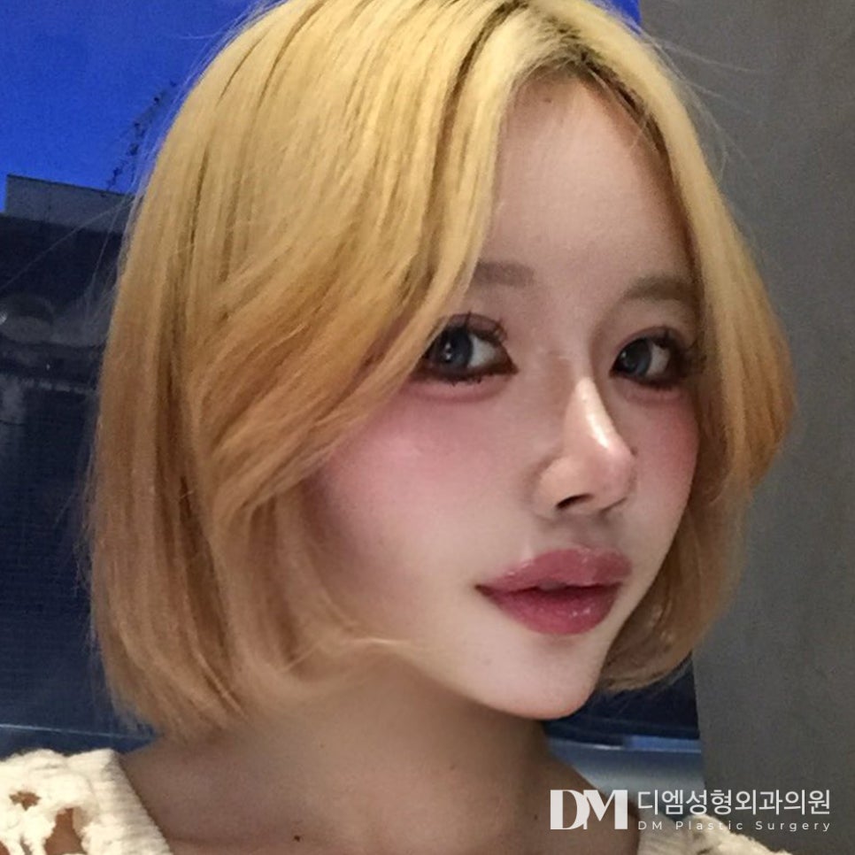 눈재수술, 숙련된 기술로 흉터를 최소화 해 내 것 처럼 관련 이미지 1