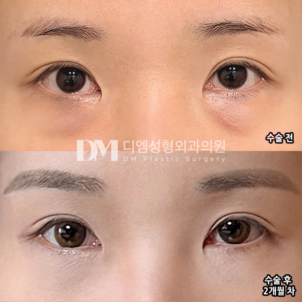 디엠 눈밑지방재배치 후기사진, 단순한 지방 제거와는 다릅니다! 관련 이미지 2