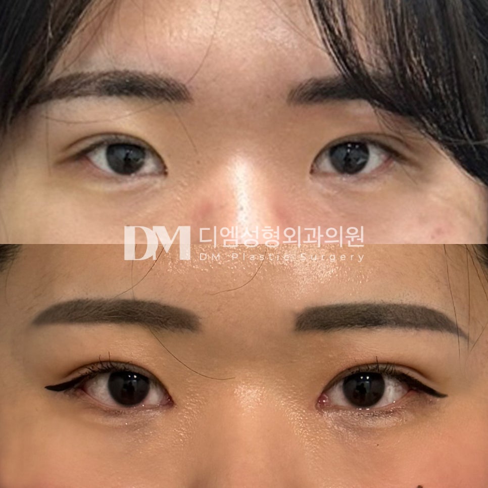 트임성형 후기."자연스럽게 잘 됐다고 칭찬을 많이받아서 좋아요!" 관련 이미지 2