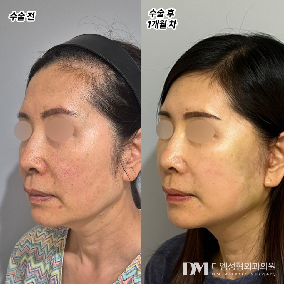 Facelift Review. "The wrinkles have definitely improved, so they’re extremely satisfied!!" image 2