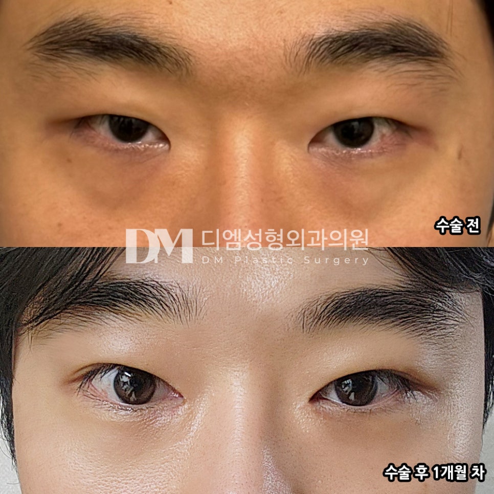 눈성형 후기."합리적인 가격에 맞춤형 상담이 좋았어요!" 관련 이미지 2
