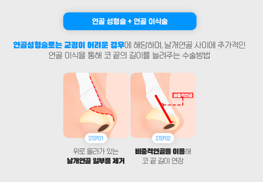 짧은코성형, 무조건 늘리고 높이기 보다 자연스럽게 맞춤형으로! 관련 이미지 6