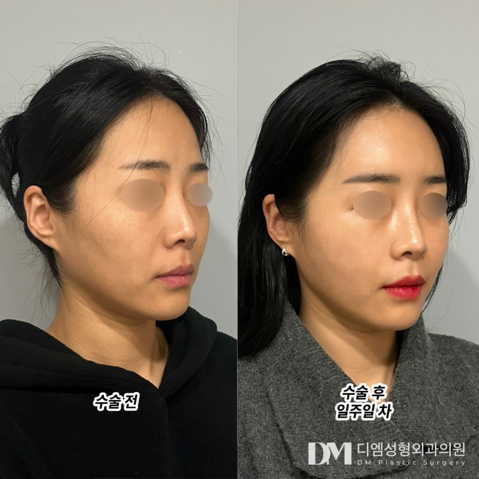 Facial Fat Grafting Review: “Worrying Only Delays the Day You Become More Beautiful!” image 2
