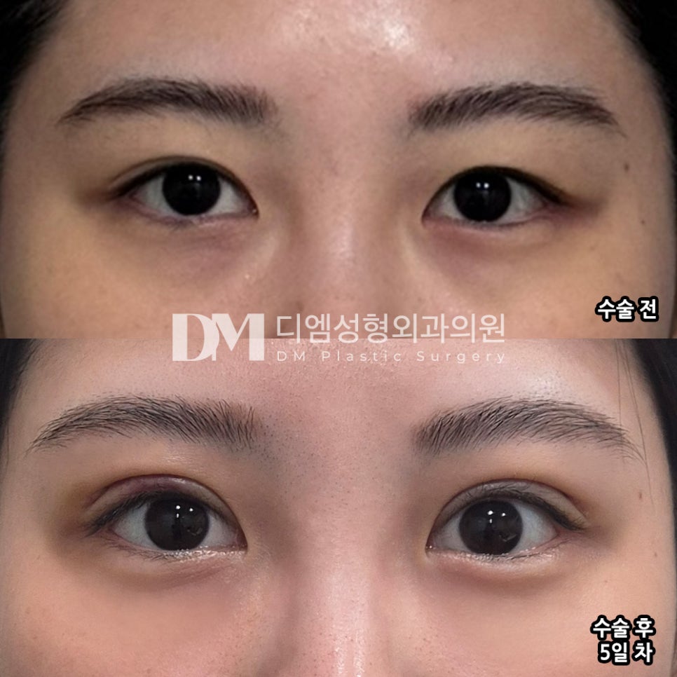 눈재수술 후기."재수술이다보니 부담이 컸었는데도 하길 잘했다는 생각이 들어요!" 관련 이미지 2