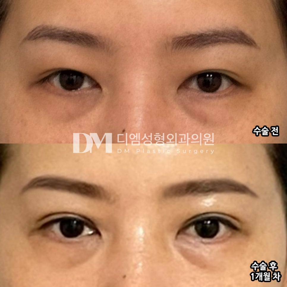 눈성형 후기."불편한 점 없어서 좋아요!" 관련 이미지 2
