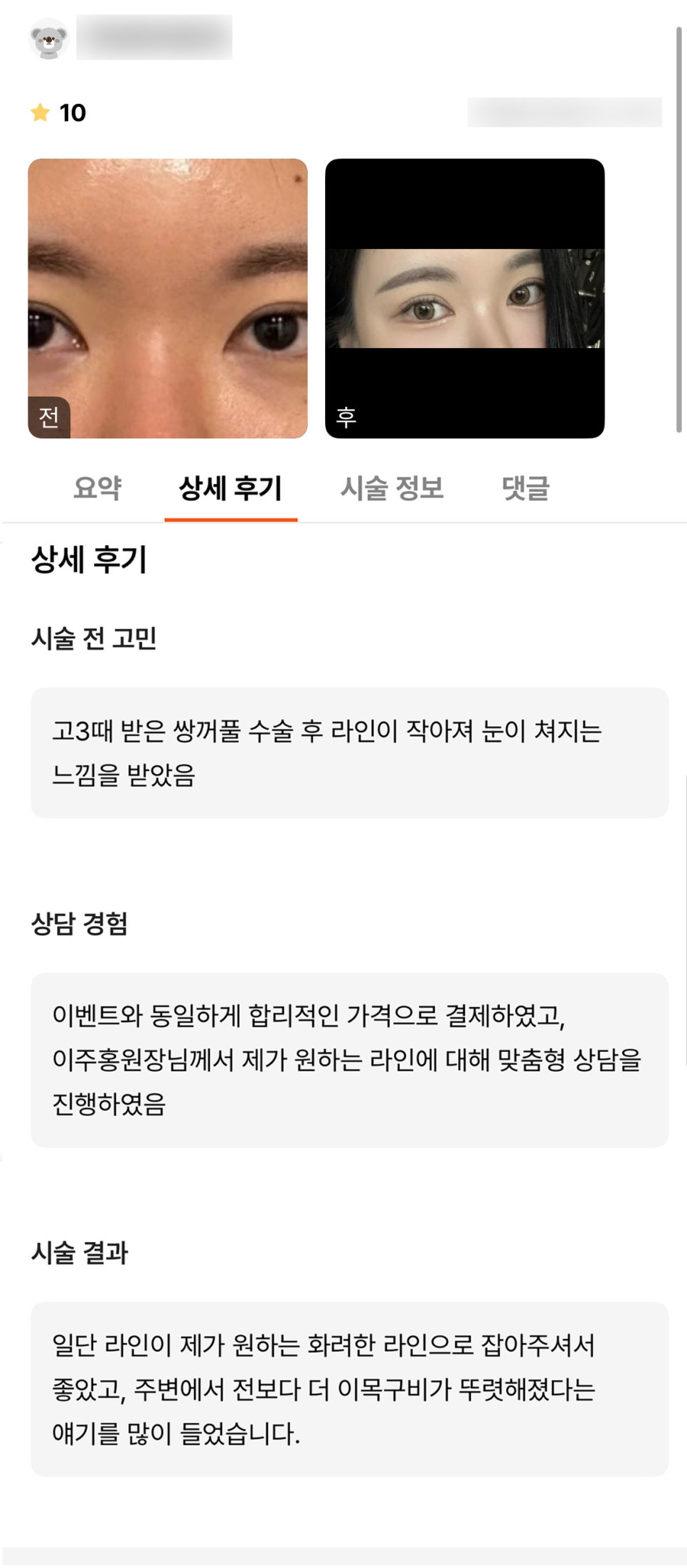 눈재수술 후기."주변에서 이목구비가 더 또렷해졌대요!" 관련 이미지 1