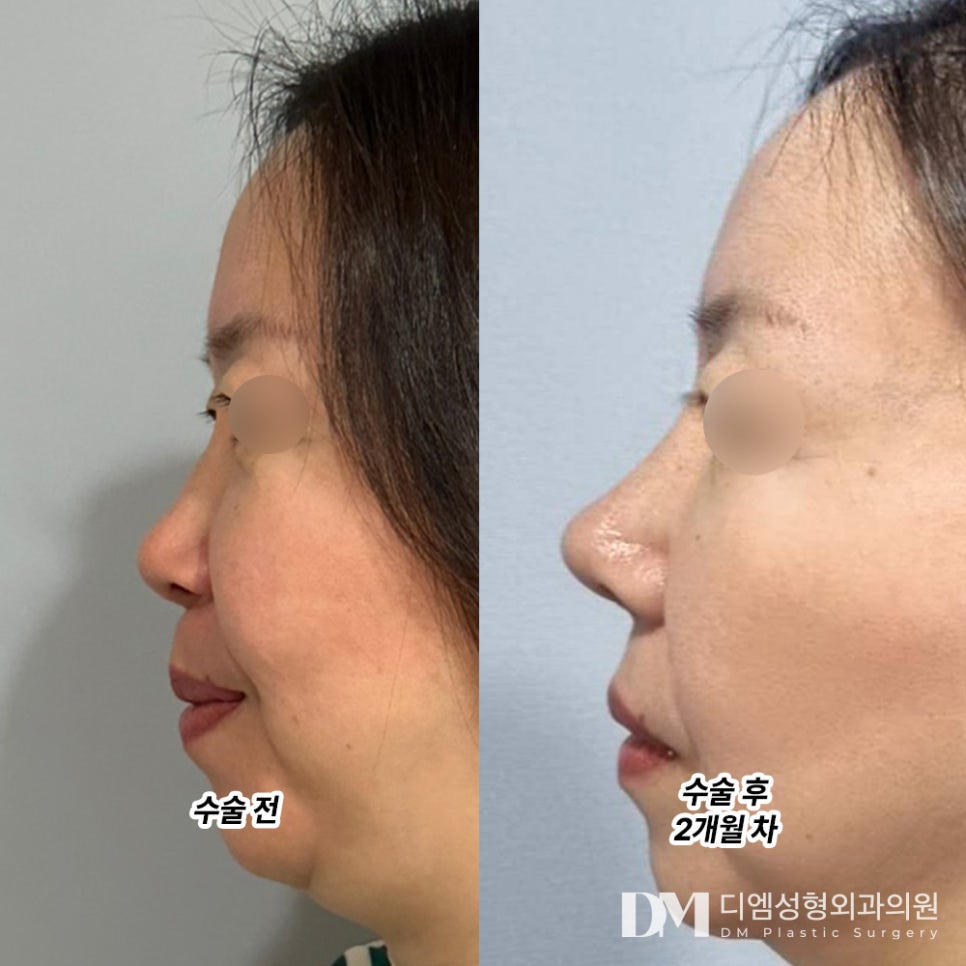 Rhinoplasty Review: “My nose has gradually become more natural, and my confidence has increased!” image 2