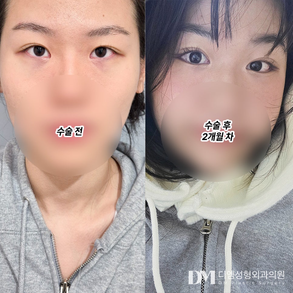 Lateral and Lower Canthoplasty Review. "I think it makes the eyes look much bigger and is the best for changing your impression!" image 2