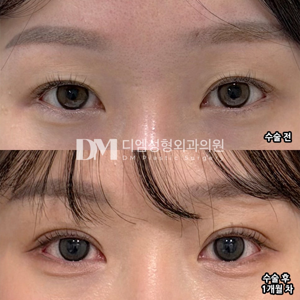 디엠 눈재수술 후기, &ldquo;수술하고 일상생활하는데 큰 지장 없었어요!&rdquo; 관련 이미지 2