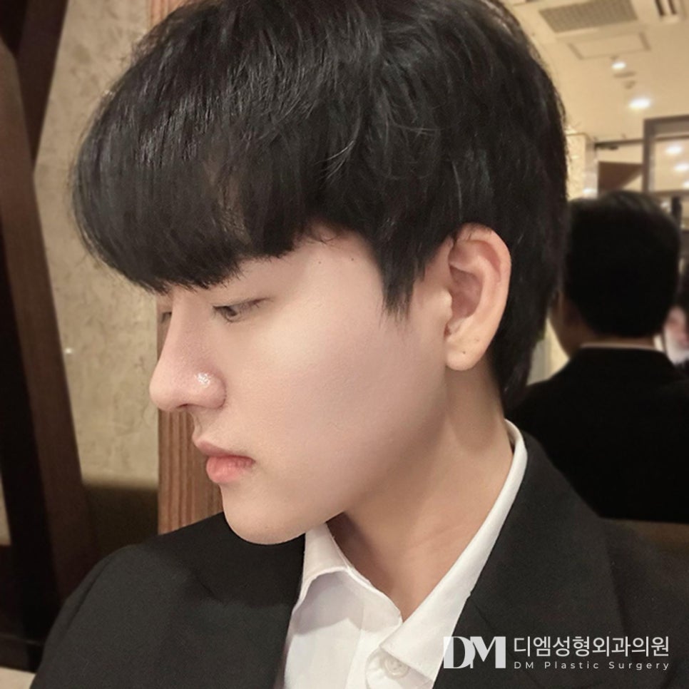디엠 남자코성형 전후사진, 코 하나로 달라지는 인상! 관련 이미지 3