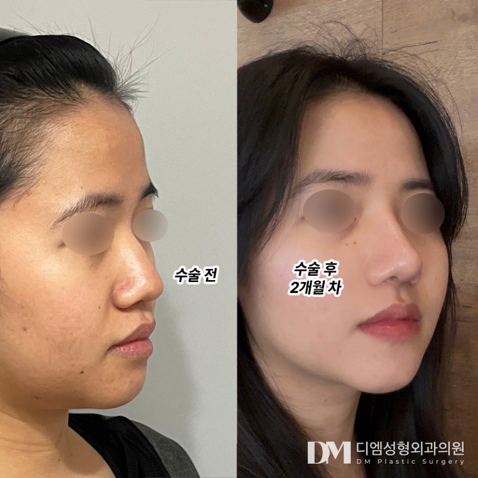 Improving a Bumpy, Conspicuous Aquiline Nose image 6