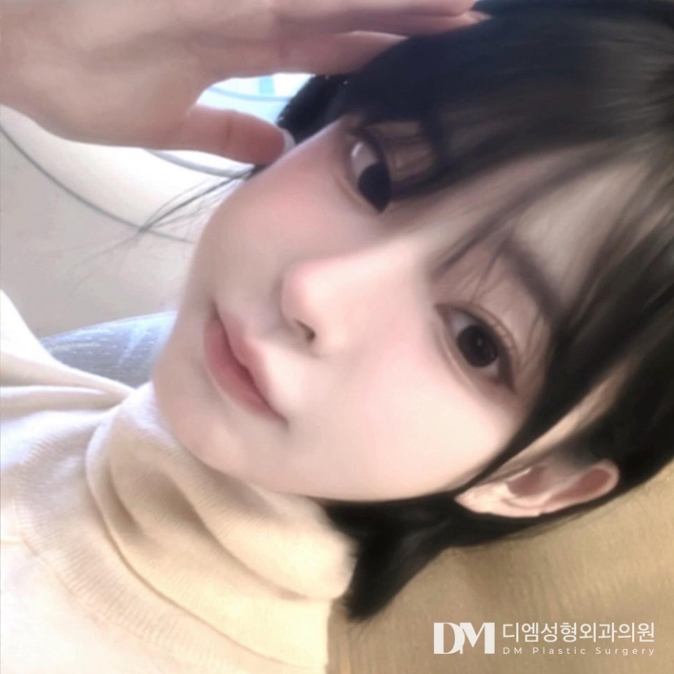 긴코,화살코 성형 짧은 중안부가 대세! 관련 이미지 1