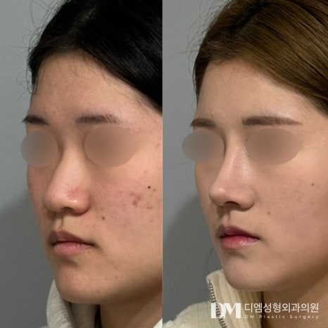 코성형 후기."더 빨리할 걸 후회하고 있습니다 !" 관련 이미지 3