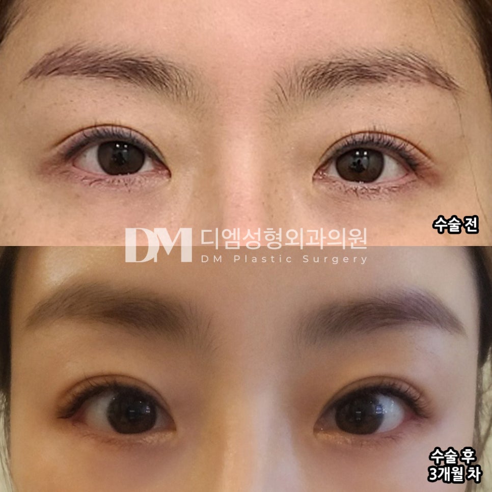 빵트임 후기."뒤트임 하나로 삶이 편해지고 만족도가 높아요!" 관련 이미지 2
