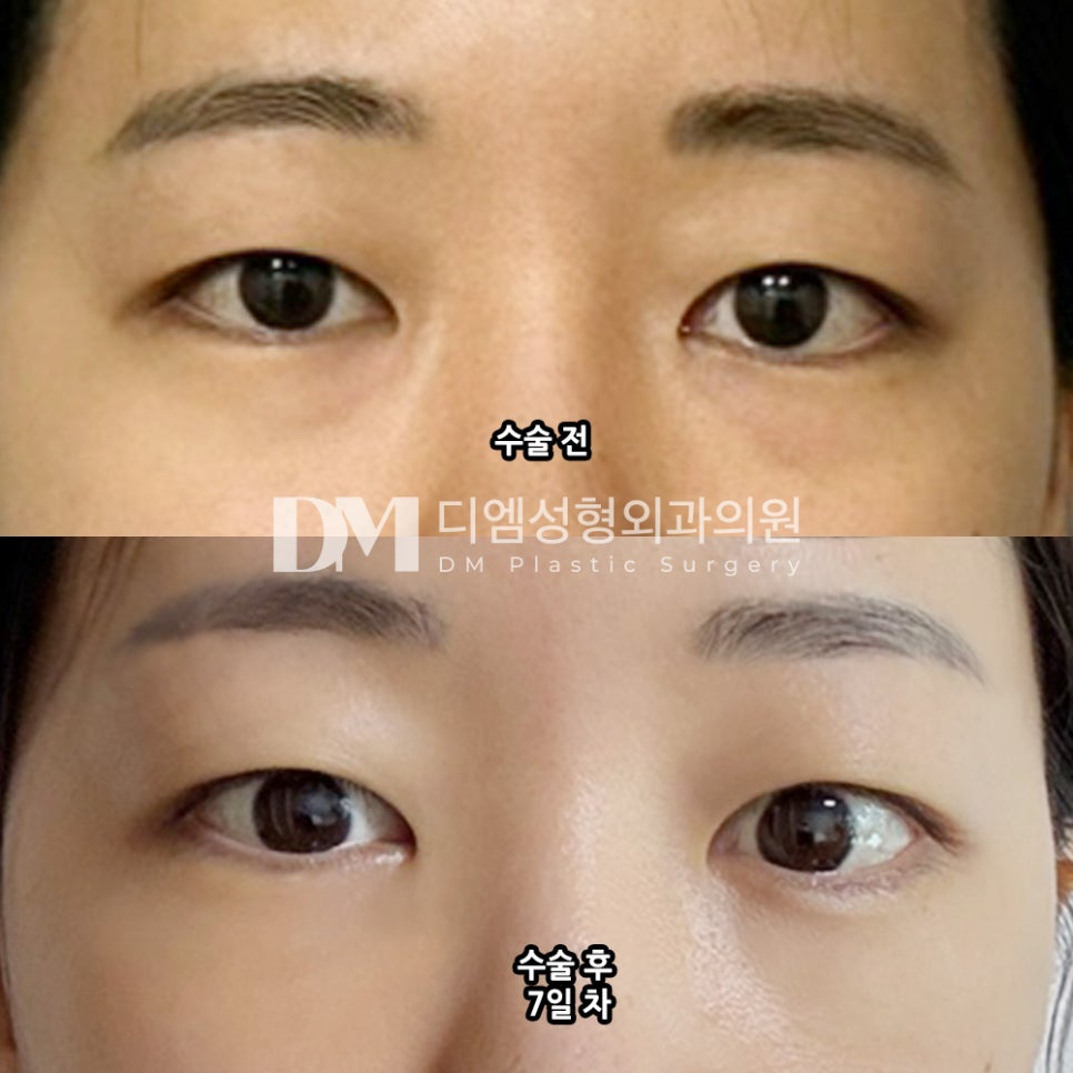 눈밑지방재배치 후기."수술 후 친절한 응대가 좋아요" 관련 이미지 2