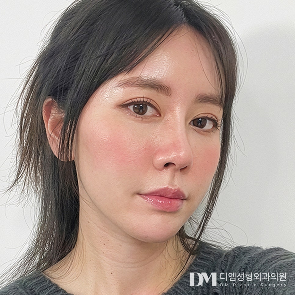 뒤트임과 밑트임 동시에 가능한 트임성형, 빵트임 수술대상은? 관련 이미지 1