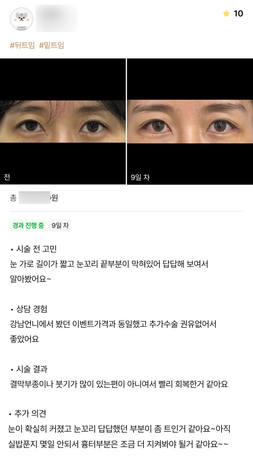 Review of Ppangteum. "My eyes definitely look bigger, and the part at the outer corners that felt cramped seems a bit more open now~" image 1
