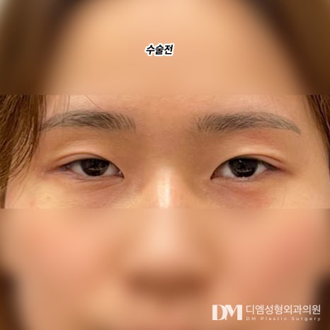 눈성형 후기."너무 자연스럽게 잘 됐어요!" 관련 이미지 2