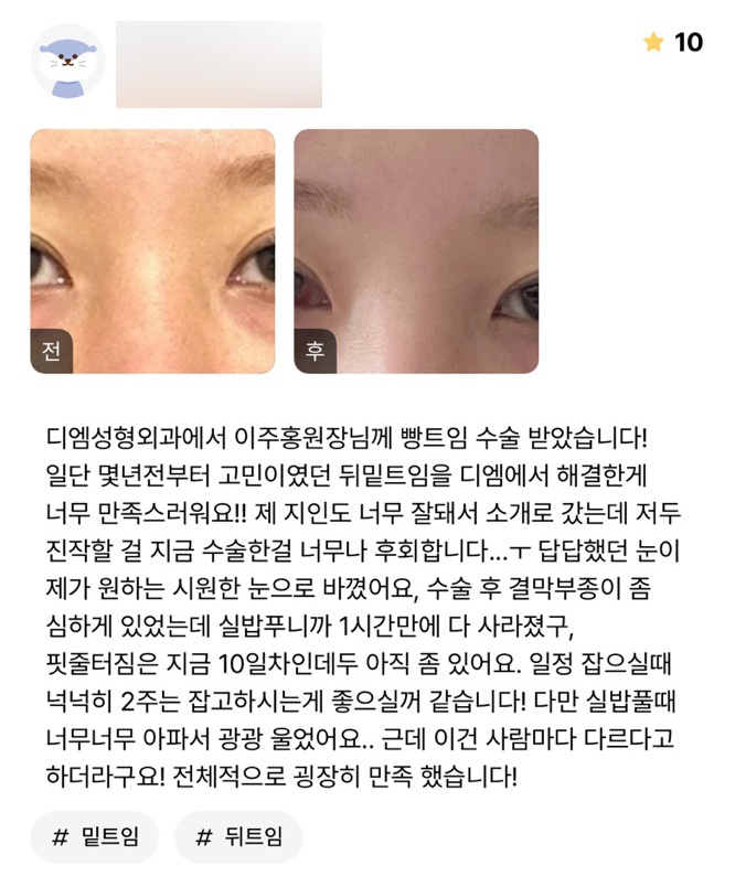 빵트임 후기."답답했던 눈이 제가 원하는 시원한 눈으로 바뀌었어요!" 관련 이미지 1