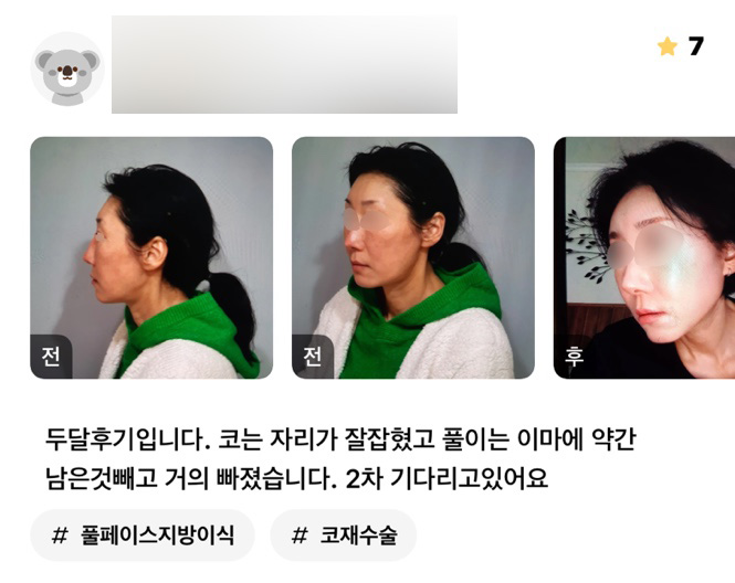 Revision Rhinoplasty Review: “The Shape of My Nose Turned Out So Well!” image 1