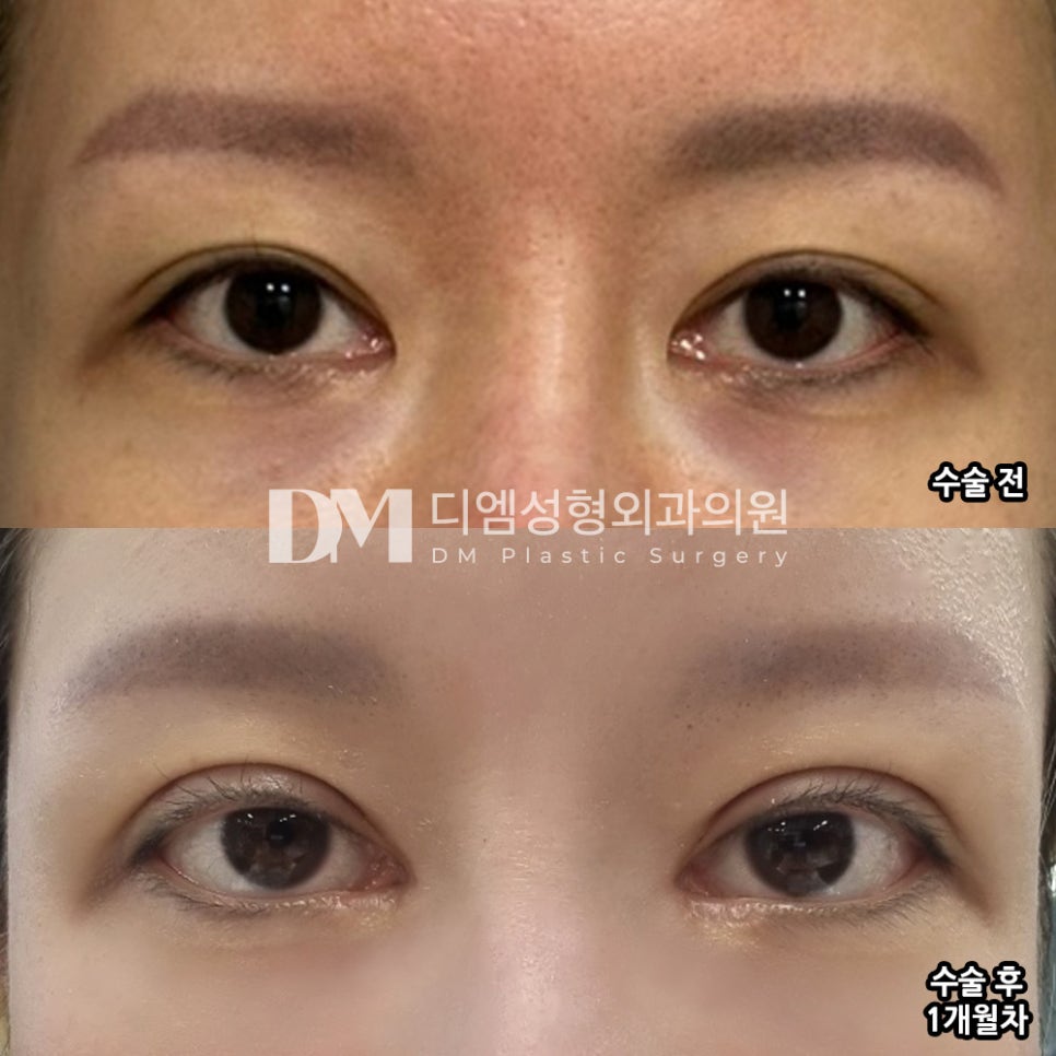 눈성형 후기."자연스러워서 일상생활에 전혀 불편함이 없어요!" 관련 이미지 2
