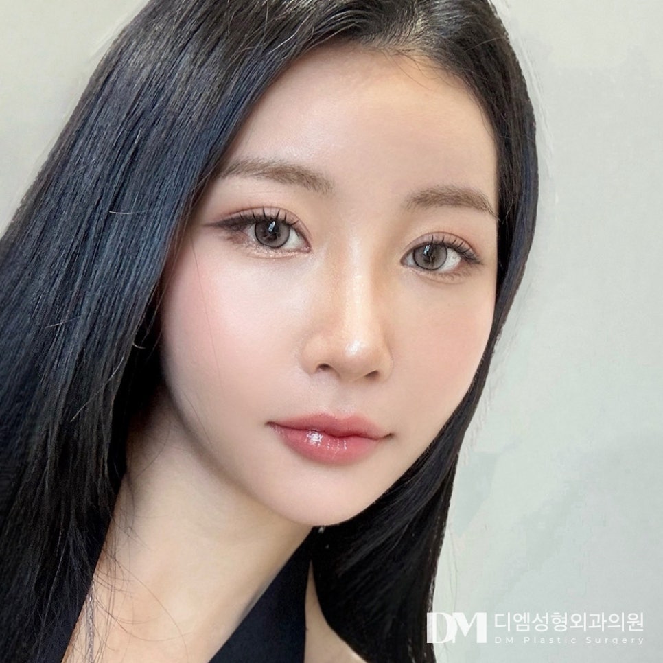 눈재수술, 또 다시 실패는 없어야 하니까! 관련 이미지 1