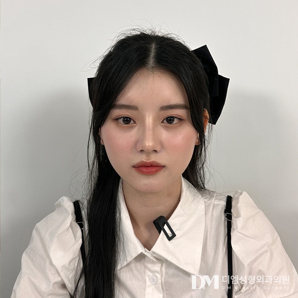 짧은코성형 하나만으로도 입체적인 얼굴로 ! 관련 이미지 1