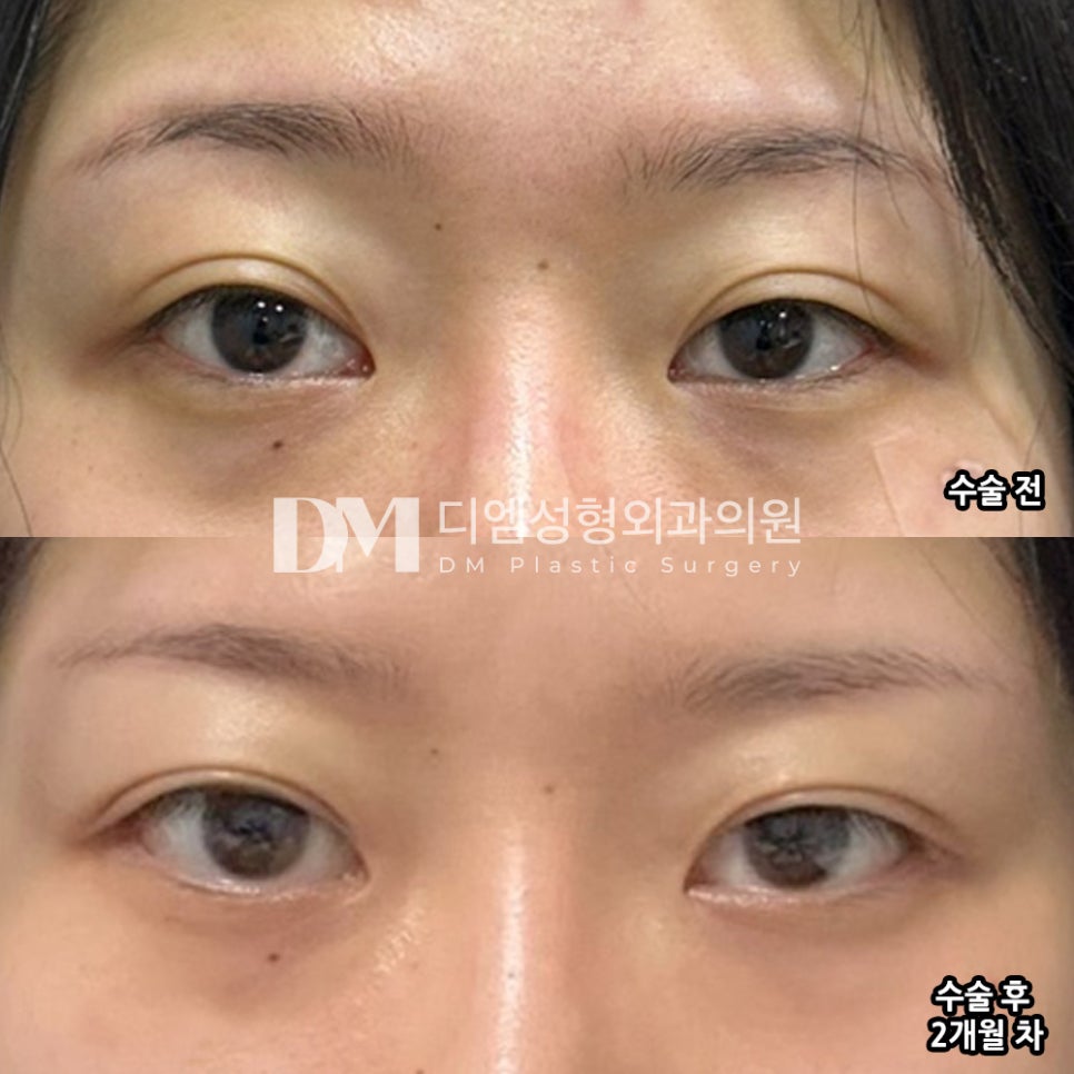 빵트임 후기."눈매가 전보다 시원한 느낌이라 너무 좋아요 ! " 관련 이미지 2
