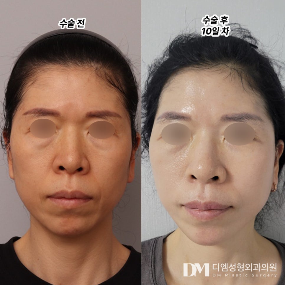 Facelift Review. "Now I Feel Confident Wherever I Go, So I’m Satisfied" image 2