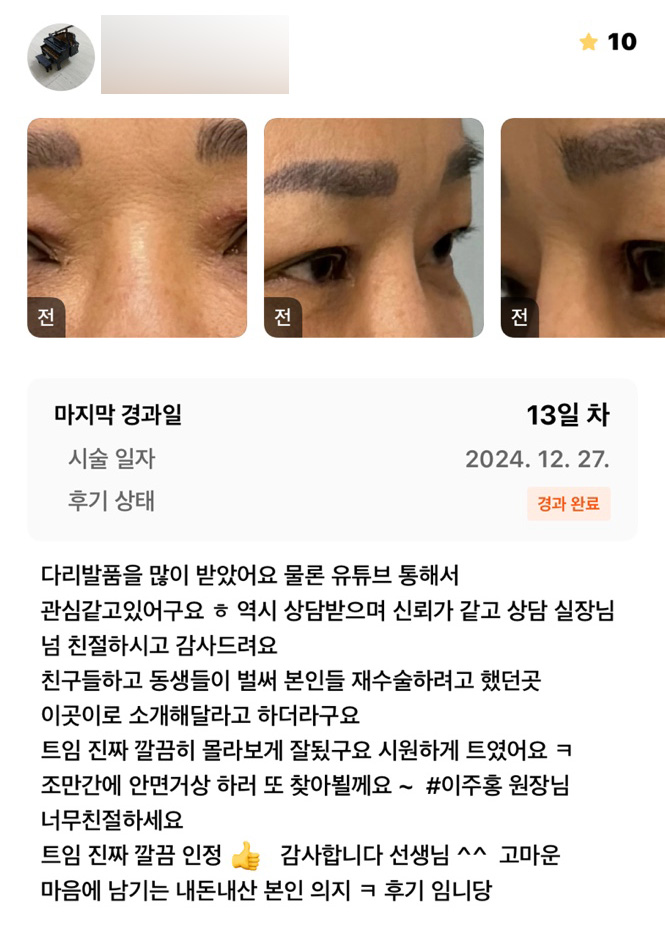 눈성형 후기."깔끔히 몰라보게 잘됐어요!" 관련 이미지 1