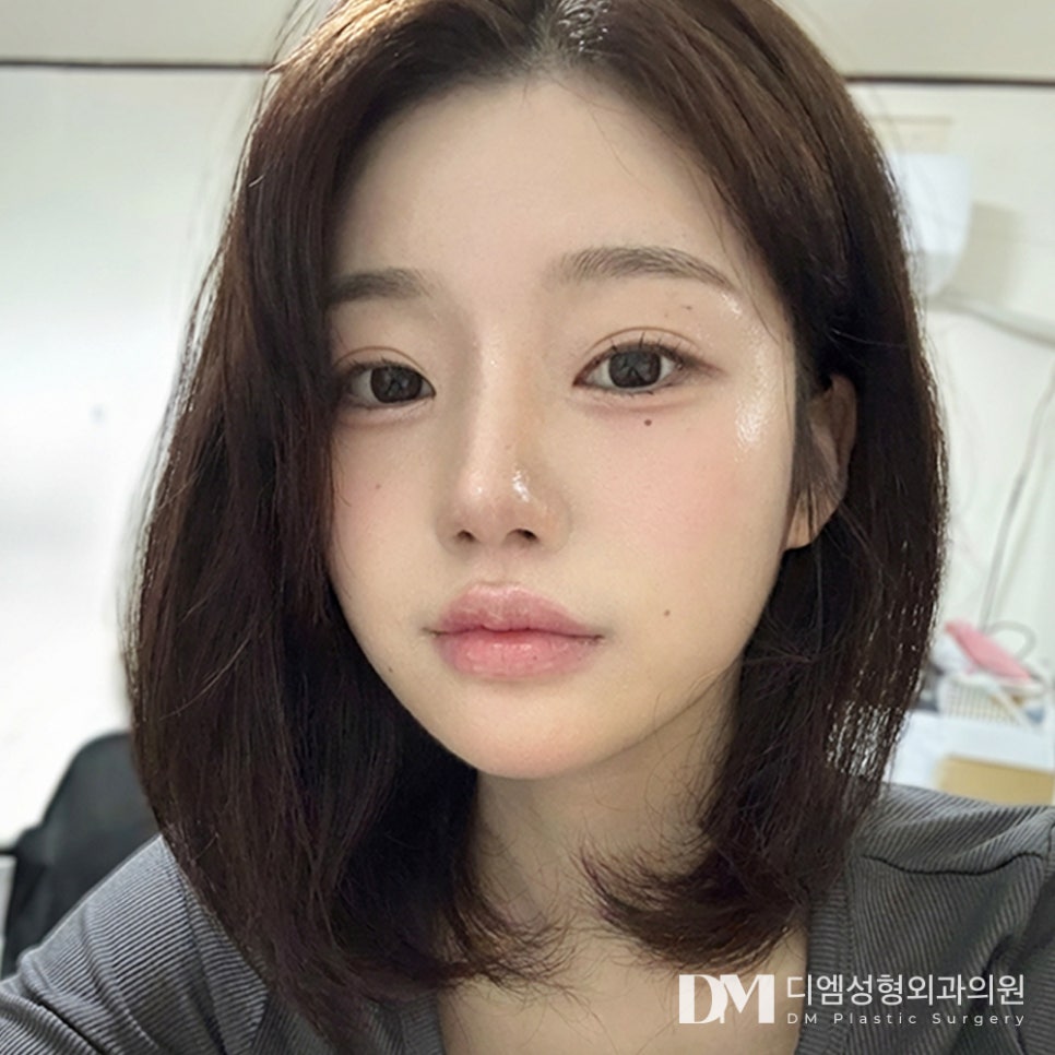 디엠 코성형 전후사진, 뭉툭한 코끝 탈출! 자려한 코로 변신! 관련 이미지 1
