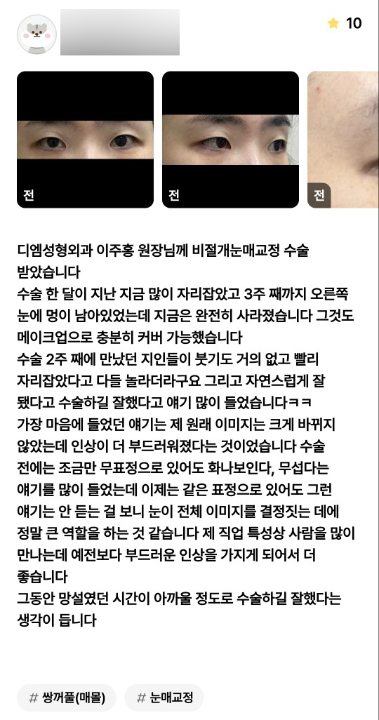 Eye Surgery Review. "I feel that I made the right decision having the surgery—it was almost a waste to have spent so much time hesitating." image 1