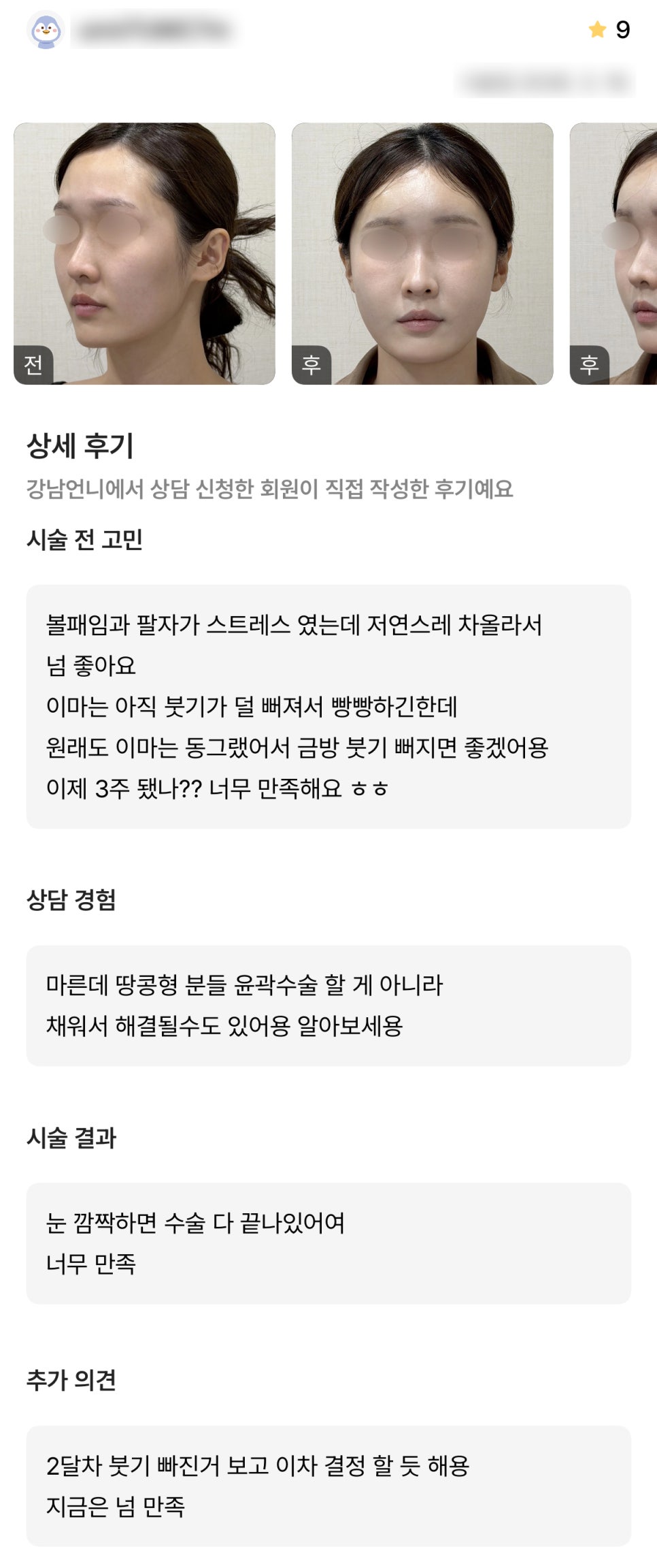 디엠 얼굴지방이식 후기, “자연스럽게 차올라서 너무 좋아요!” 관련 이미지 1
