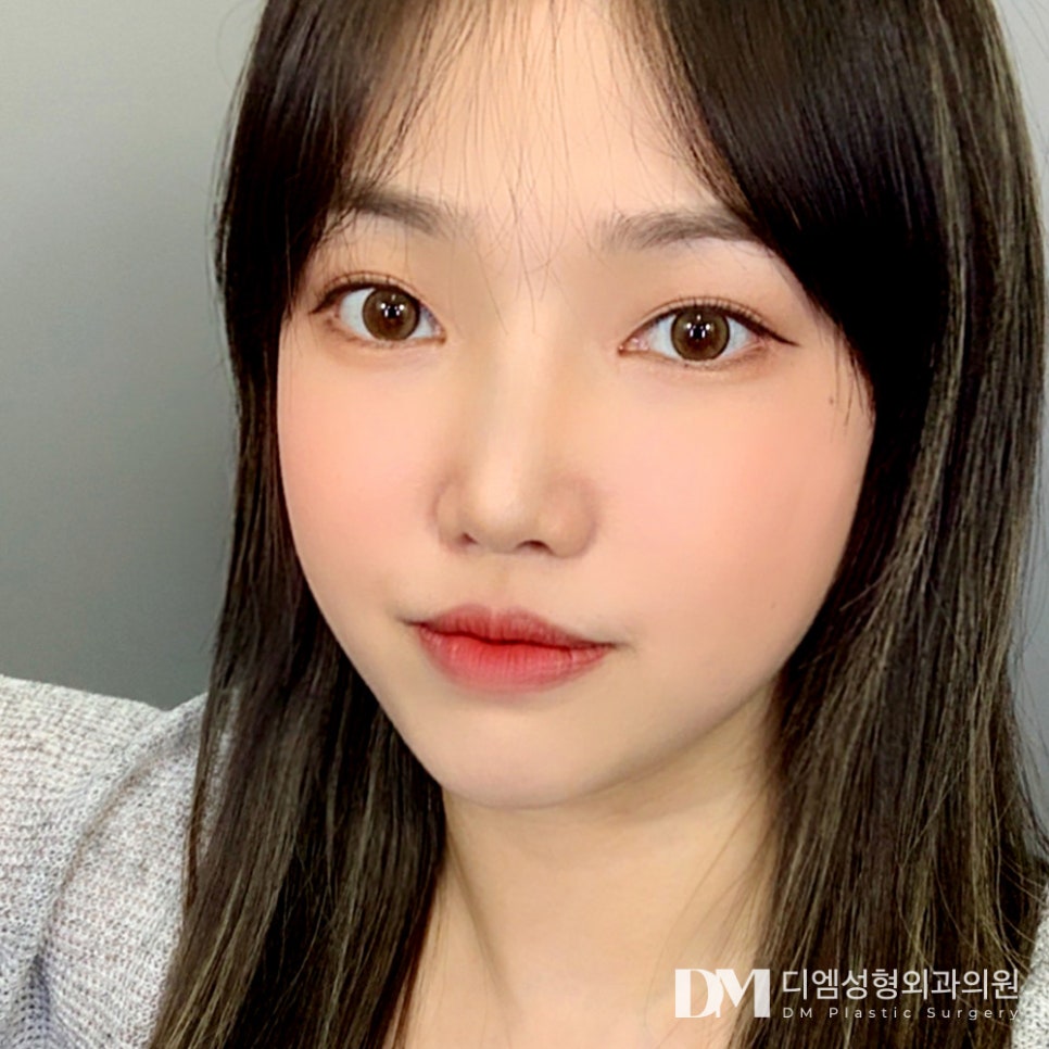 뒤밑트임, 자연스럽게 시원한 눈매로 관련 이미지 9