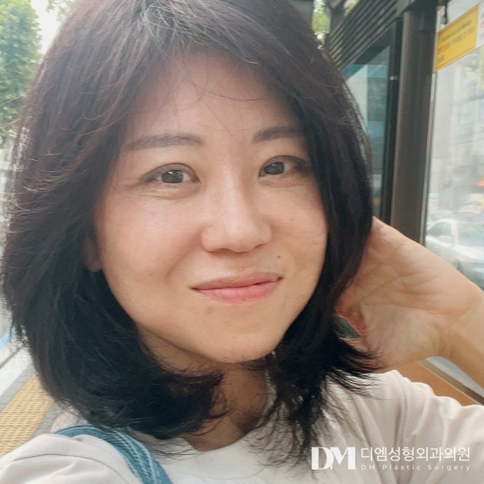 디엠 안면거상 전후사진, 무너진 얼굴 라인이 고민이라면? 관련 이미지 1