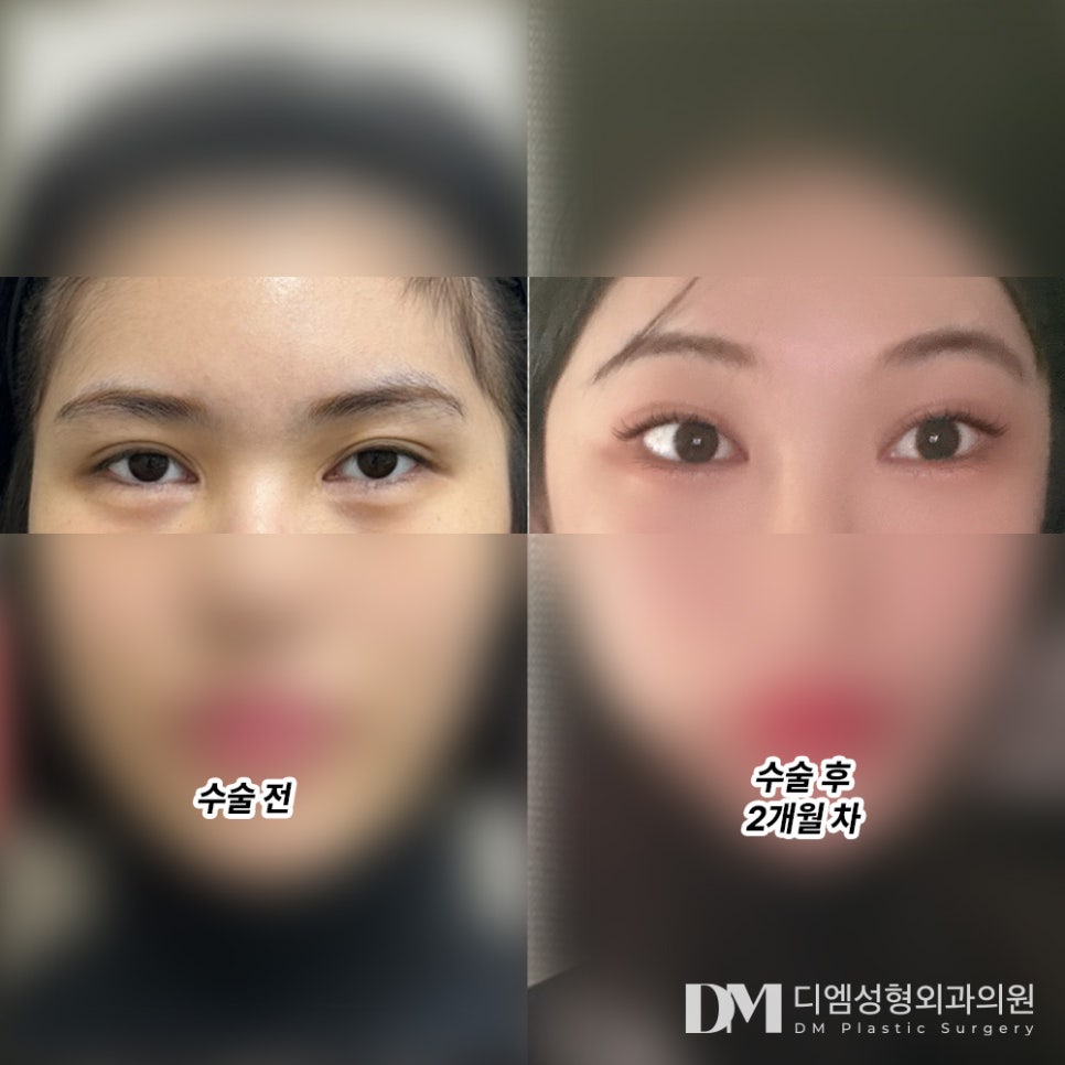 엔도타인 없는 내시경 이마거상, 장치 부담감 제로! 관련 이미지 7