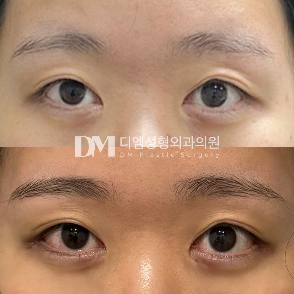 Eye-Opening Surgery Review. “Recommended if you want to give your eyes a more open, refreshed look!” image 2