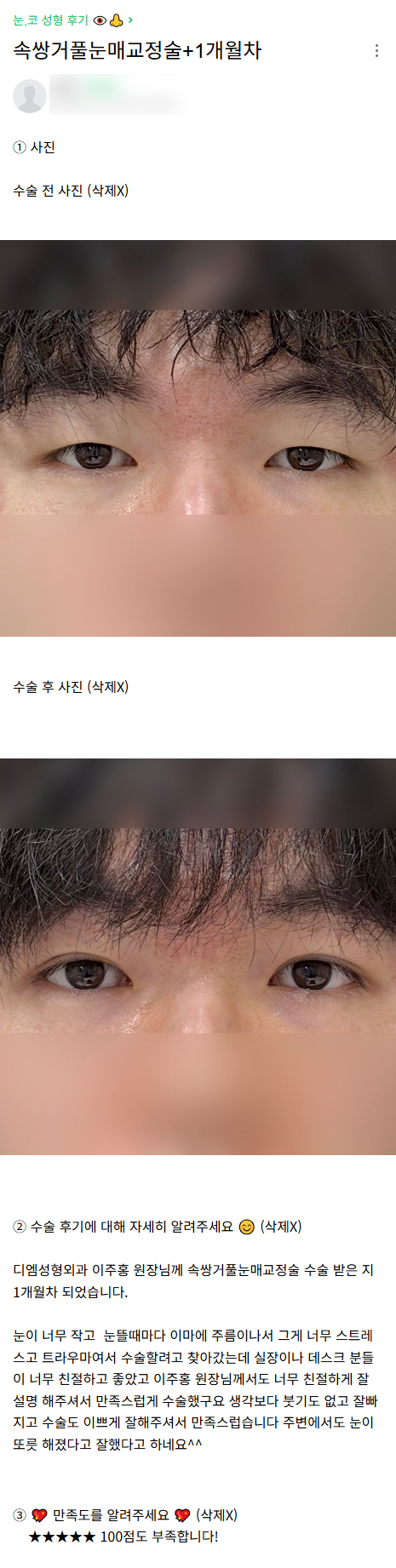 디엠 남자눈매교정 후기, “주변에서 눈이 또렷해졌다고 합니다!” 관련 이미지 1