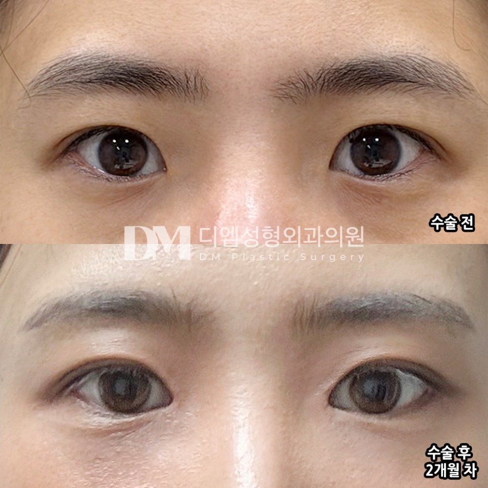디엠 트임성형 전후사진, 전체적으로 답답한 눈매 개선 방법은? 관련 이미지 2