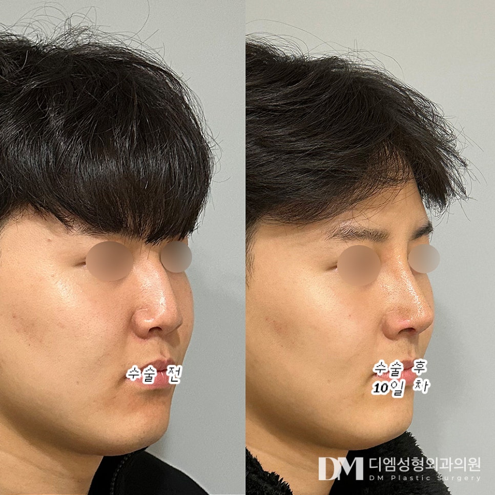 코성형 후기."생각보다 붓기도 거의 없고 통증도 없어 일상 생활에 전혀 불편함이 없었습니다" 관련 이미지 2