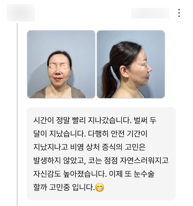 Rhinoplasty Review: “My nose has gradually become more natural, and my confidence has increased!” image 1