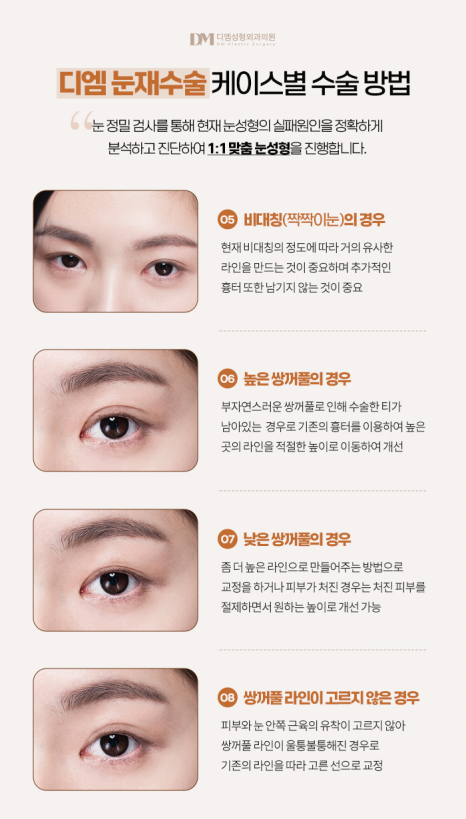 눈재수술, 쌍꺼풀이 풀려 비대칭 눈매가 되었다면? 관련 이미지 7