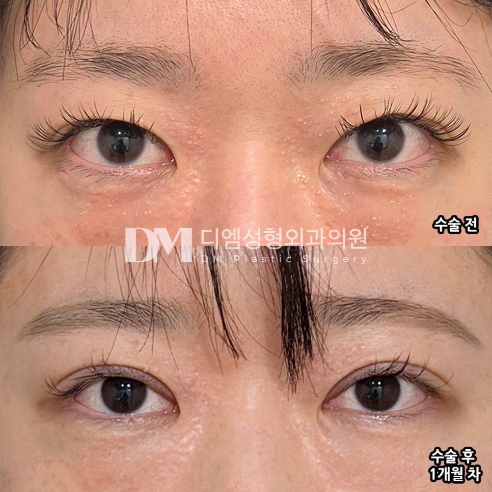 디엠 눈재수술 후기, “너무 만족합니다! 이주홍 원장님 최고예요!” 관련 이미지 2