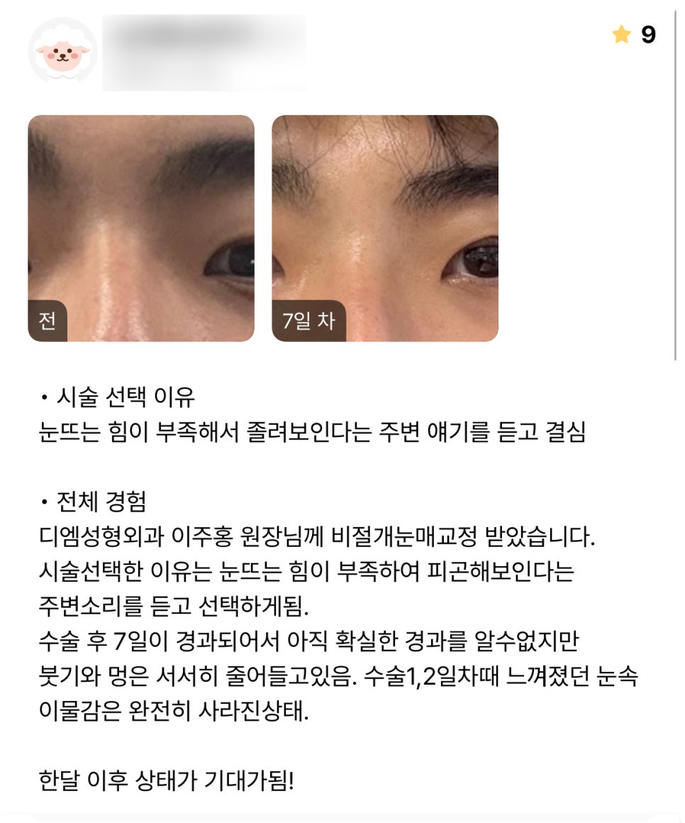 눈성형 후기."한달 후가 기대돼요!" 관련 이미지 1