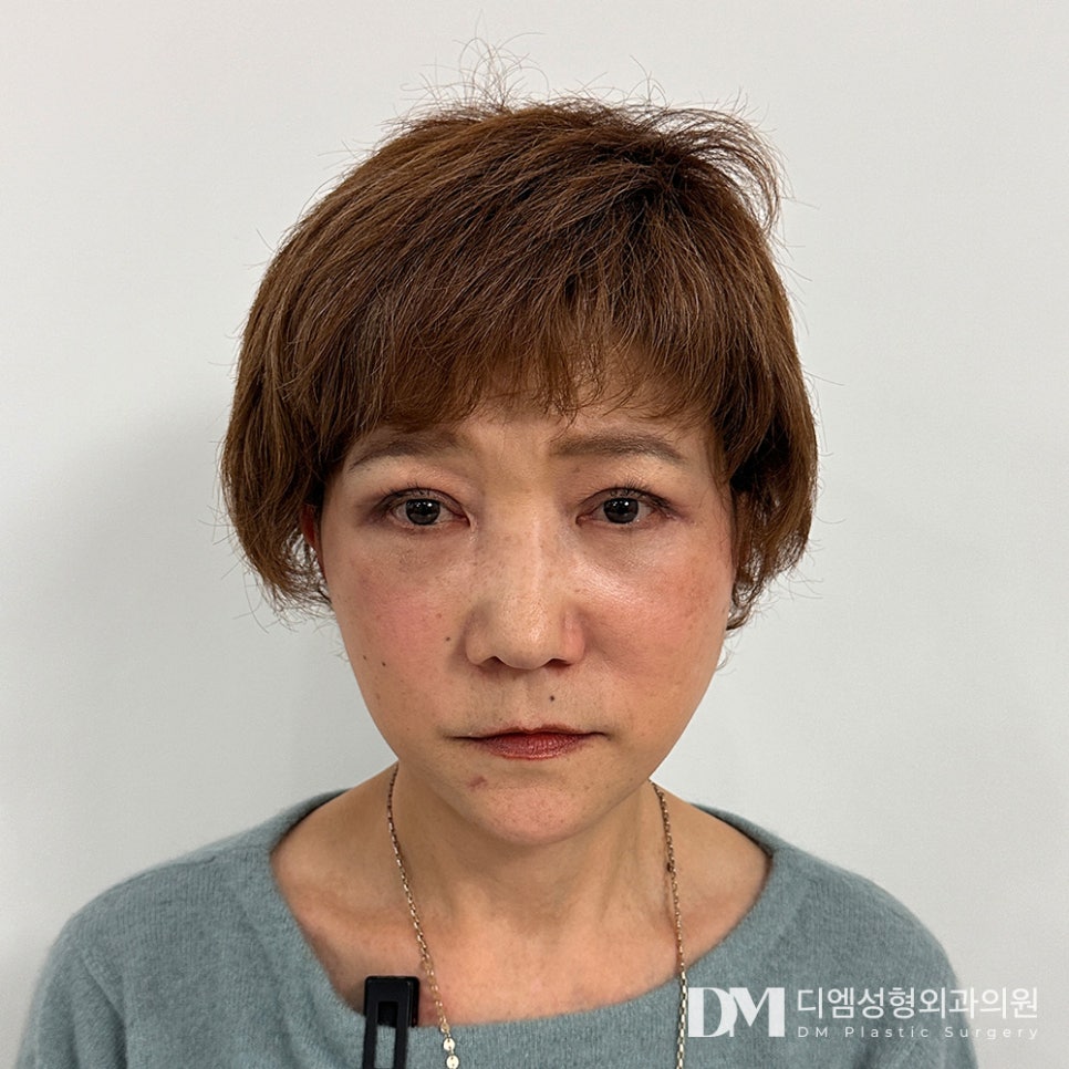 Upper Blepharoplasty: If You’re Concerned About Drooping Eyelids Caused by Aging image 13