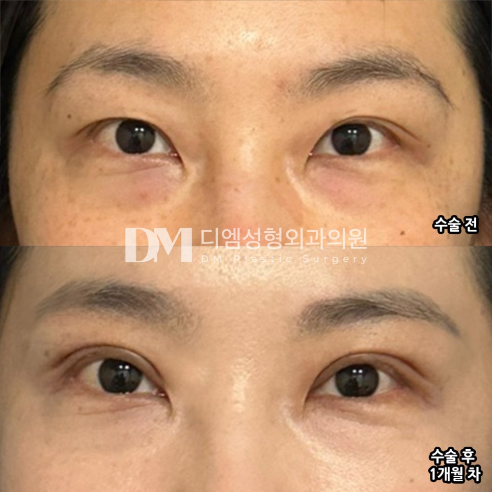 눈재수술 후기."절개하실 분들 강추합니다 ~" 관련 이미지 2